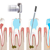 Endodonti